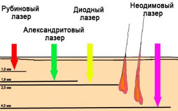 неодимовый лазер особенности и отзывы